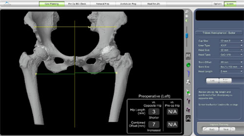 Preoperative anatomy seen on CT scan