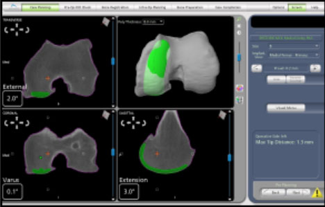 CT scan of the knee