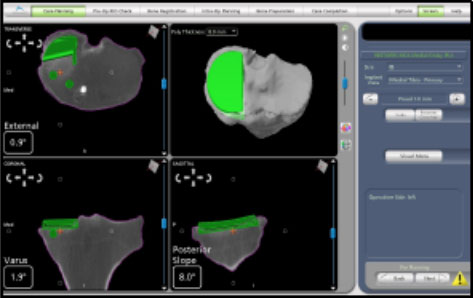 CT scan of the knee