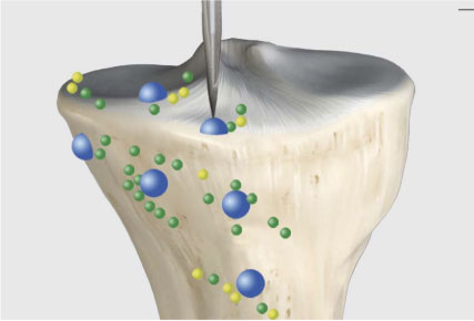 Robotic Partial Knee Replacement