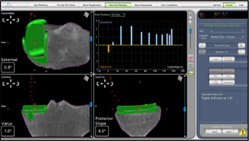 Robotic Partial Knee Replacement