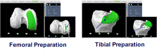 Robotic Partial Knee Replacement