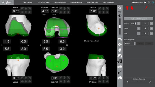 CT scan of the knee 